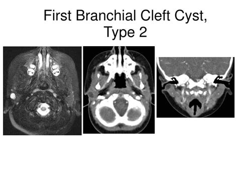 PPT - Branchial Cleft Cysts PowerPoint Presentation - ID:259307