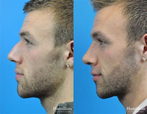 Rhinoplasty Before & After Gallery