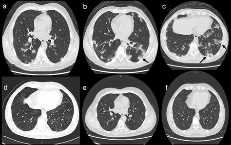 (a-c) Bilateral patchy pulmonary infiltrates are seen mostly in the... | Download Scientific Diagram