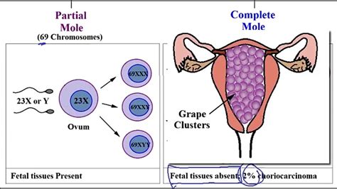 Molar+pregnancy,+partial+and+complete+hydatidiform+mole - YouTube