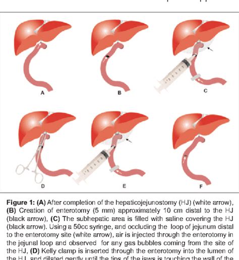 Table I from Intraoperative Dilatation and Air-Tight Testing of the Hepaticojejunostomy: A New ...