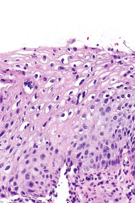 Low-grade squamous intraepithelial lesion - Libre Pathology