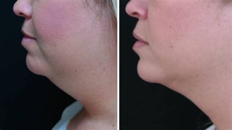 CoolSculpting Cleared by FDA to Use on Double Chins | Allure