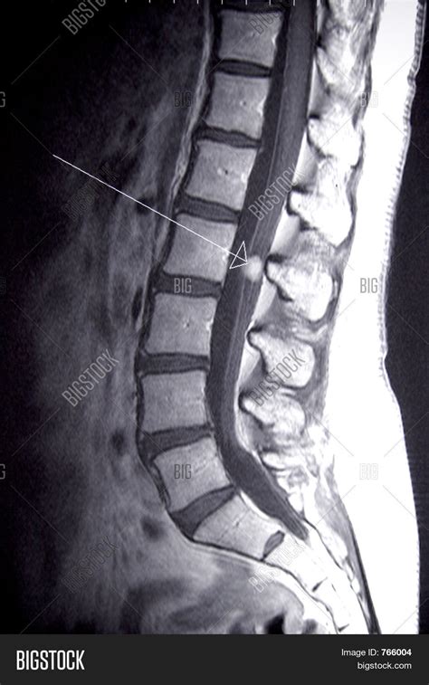 Lumbar Spine Mri Arrow Image & Photo (Free Trial) | Bigstock