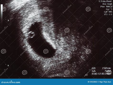 Ultrasound Scan One Month Stock Photos - Image: 5922863