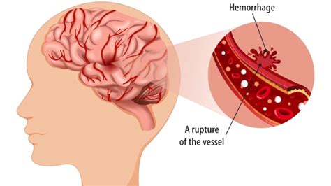 Hemorrhagic Stroke Paralysis: Causes, Symptoms, Treatment