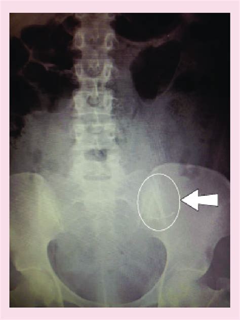 x-ray confirming levonorgestrel intrauterine system perforation at time ...