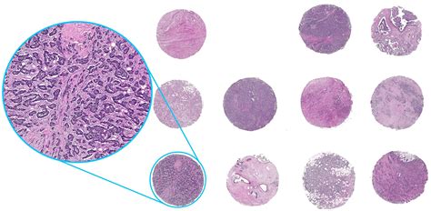 Tissue Microarrays - Cancer Controls