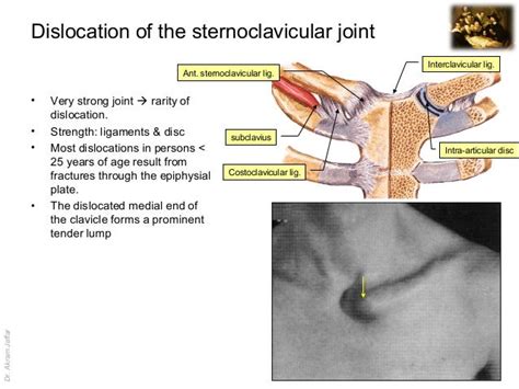 Imaging anatomy dislocation of sternoclavicular joint