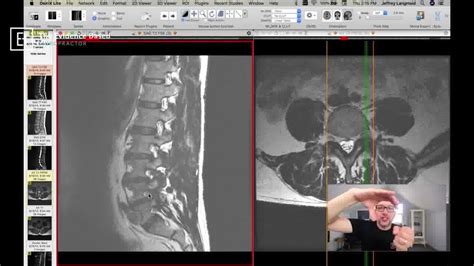 What does a pinched nerve look like on MRI? | What does a pinched nerve look like on MRI ...