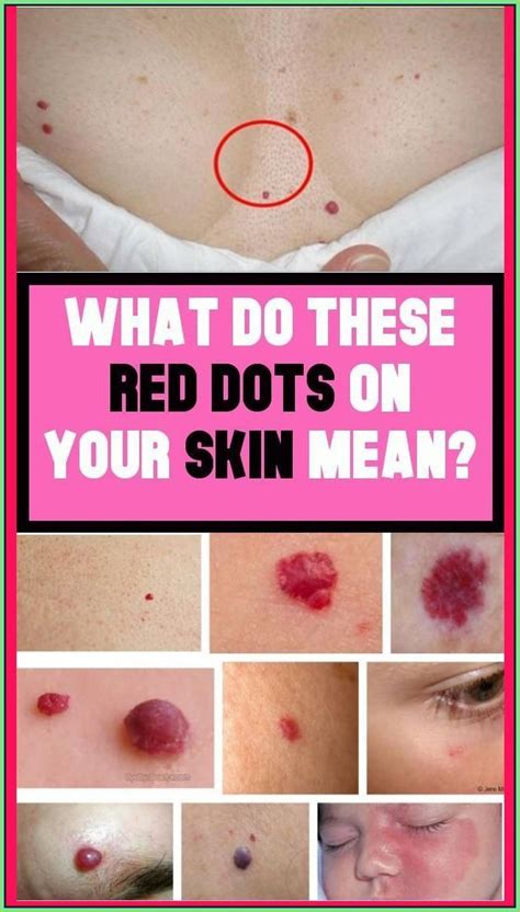 What Do The Red Moles On The Body in 2022 | Red moles, Mole, Diabetes education