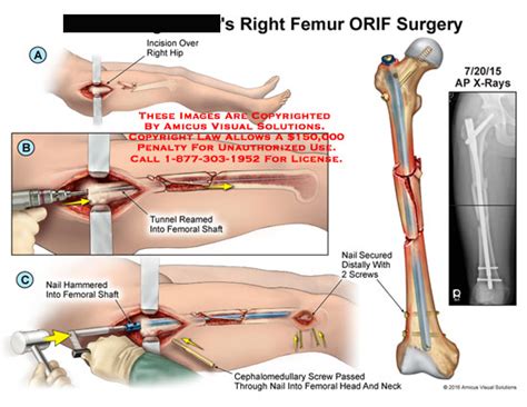 Right Femur ORIF Surgery