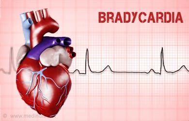 What Is Bradycardia? - Health Care Center