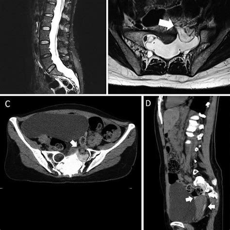 Lumbar MRI shows dural ectasia (A) and an anterior meningocele from the... | Download Scientific ...