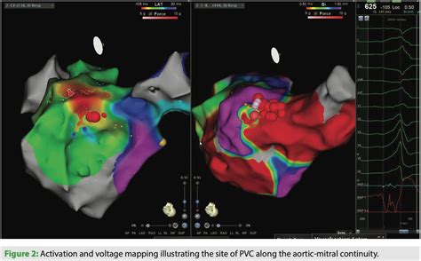 PVCs and the Role of Catheter Ablation in Current Times | EPLD