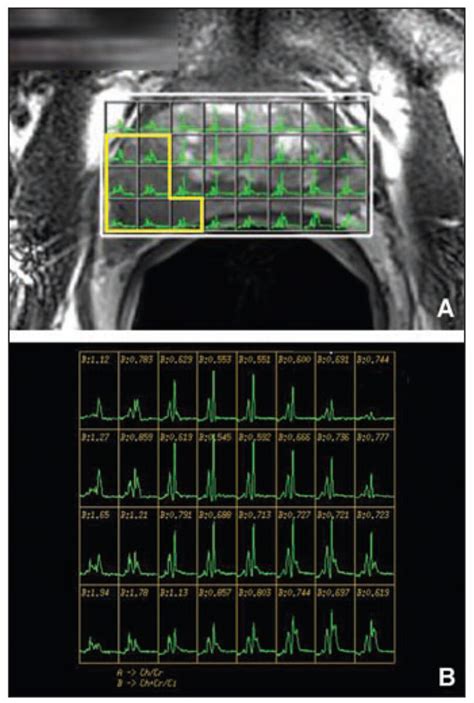 62-year-old man with biopsy-proven prostate cancer with... | Download ...