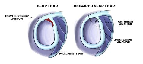 Biceps Tendon Pathology at the Shoulder | Murdoch Orthopaedic Clinic