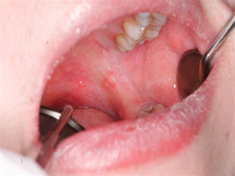 Multiple Superficial Mucoceles on Lower Lip, Soft Palate, Retromolar Region, and Floor of Mouth ...