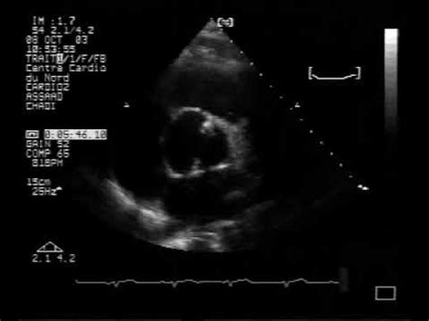 echocardiogram:calcified bicuspid aortic valve - YouTube