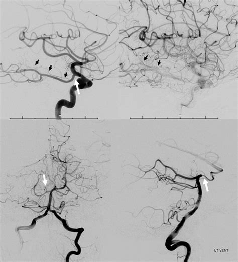 Anterior Choroidal Artery | neuroangio.org