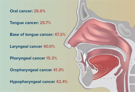 Head And Neck Cancer Diagram