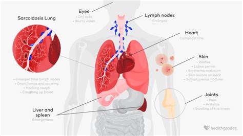 Sarcoidosis: Symptoms, Causes, and Treatments