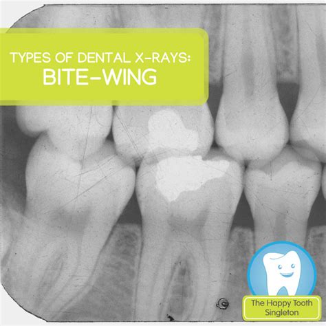 Types of dental x-rays: Bite-wing | The Happy Tooth Singleton