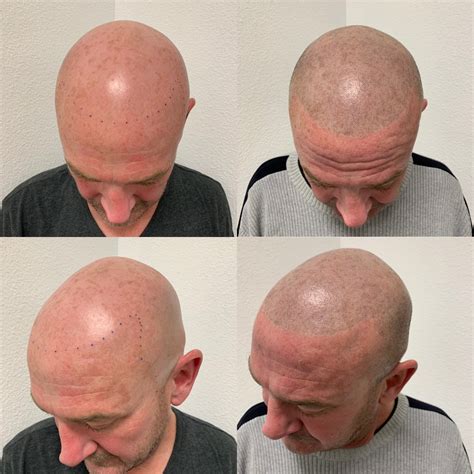 Scalp Micropigmentation Before and After Photos - SMP INK