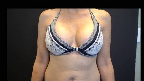 Breast Augmentation Results in a Bikini, 400cc Smooth Round Silicone ...