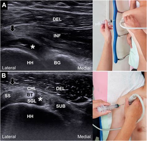 Frontiers | Ultrasound-Guided Hydrodilatation With Triamcinolone ...