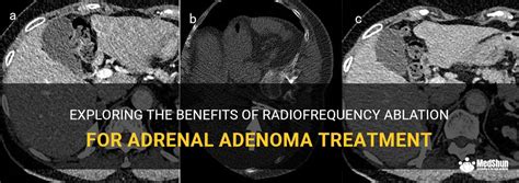 Exploring The Benefits Of Radiofrequency Ablation For Adrenal Adenoma Treatment | MedShun