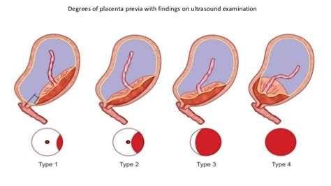 Antepartum haemorrhage