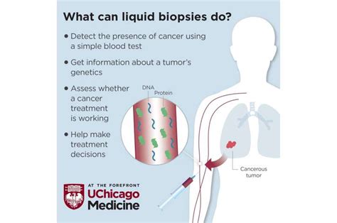 Liquid biopsy: A new tool for identifying and monitoring cancer