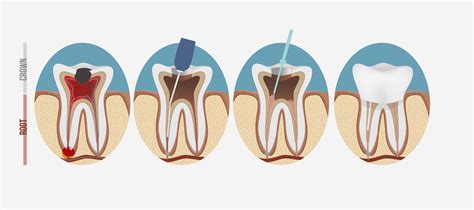 Root Canal Therapy in Christies Beach | Beach Road Dental