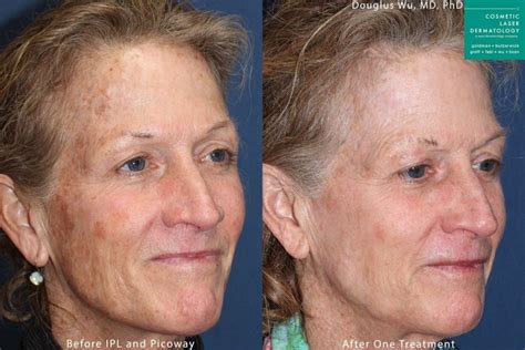 Lumenis M22 IPL Laser Resurfacing | San Diego, CA | CLDerm