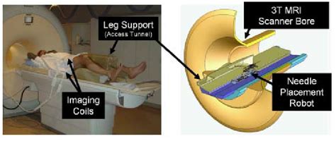 Proposed patient positioning in the semi-lithotomy position on the leg ...