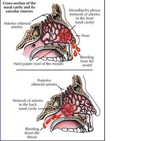 Nosebleeds – what to do when your nose bleeds | The Chestermere Anchor ...