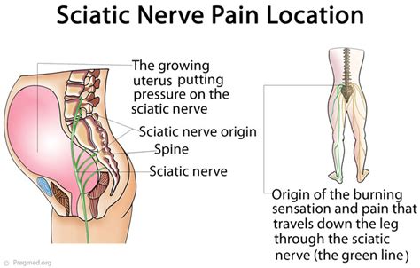 How To Sit With Sciatica Pregnancy