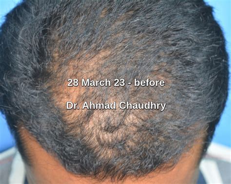 Hair treatment for men in Lahore | Free consultation | Call now