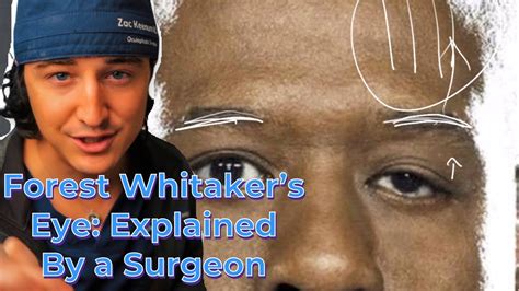 Forest Whitaker’s Eye- Explained by an Eyelid Surgeon | Understanding ...