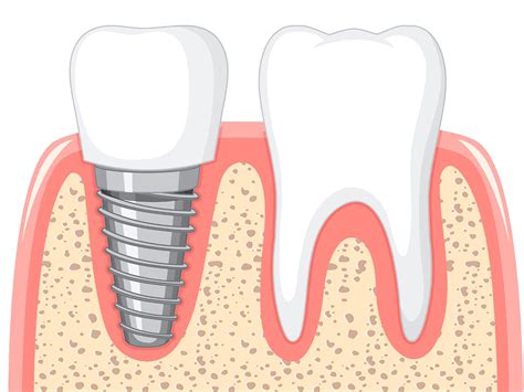 Dental Implant Pain - What to Expect Post-Implant Surgery?