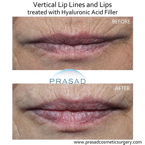 What’s the Best Treatment for Wrinkles Above Lips? | Dr. Prasad Blog