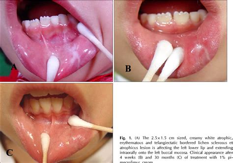 Figure 1 from Treatment of oral lichen sclerosus with 1% pimecrolimus ...