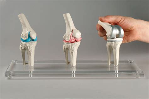 KNEE IMPLANT MODEL | More Than Simulators