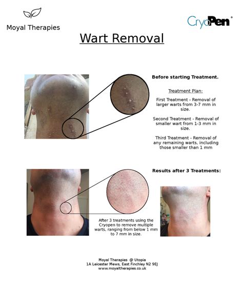 Before and After pictures of Wart Removal — MOYAL THERAPIES