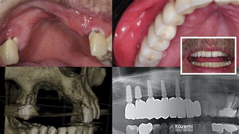 Solutions for Patients with Severe Bone Loss Who Want Dental Implants | Solutions for Patients ...