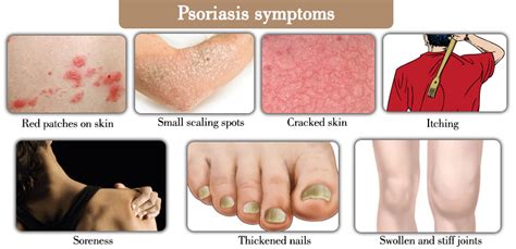 One day people with psoriasis may be able to simply go online to receive their care - https ...