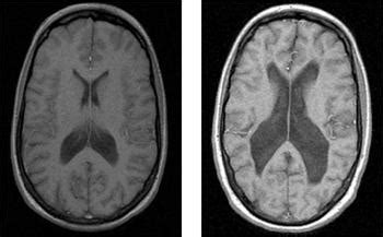 Schizophrenia Brain Scan