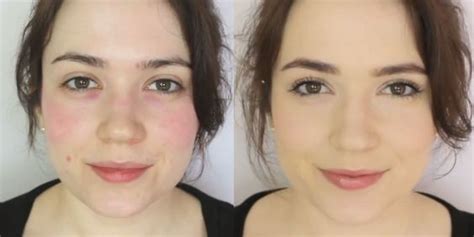 5 Easy Steps to Covering Up Redness With Makeup | Best makeup for rosacea, Rosacea makeup ...