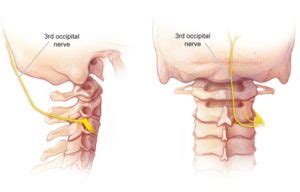 Occipital Nerve Radiofrequency Denervation - Pain management clinics in ...